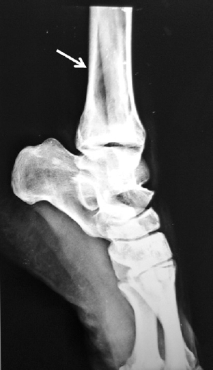 X-ray of the right ankle showing bone cysts in the tibia (arrow).